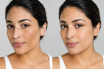 Hyperpigmentation Treatment Results, Explained